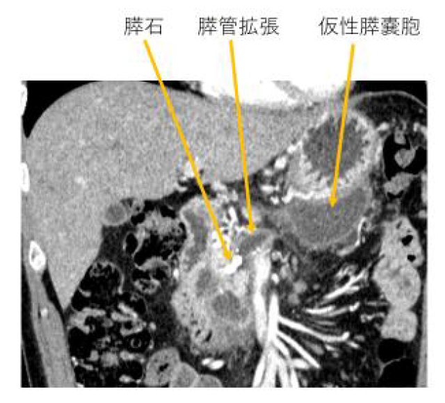 慢性膵炎 | 肝胆膵外科 - 名古屋市立大学 大学院医学研究科 消化器外科学