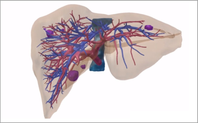 3次元画像解析システムによる肝臓の立体構築