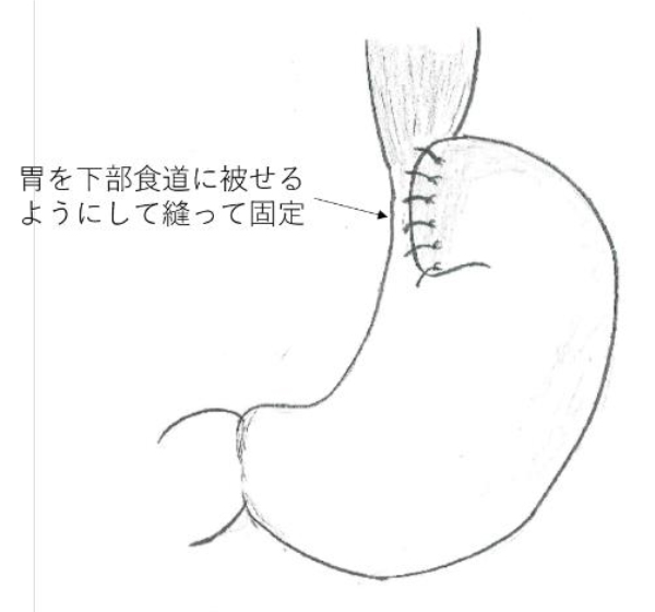 図3. ドール手術